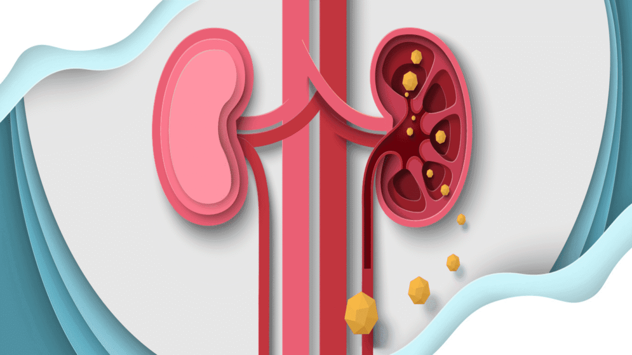 Why kidney stones happen - and the modern ways to treat them